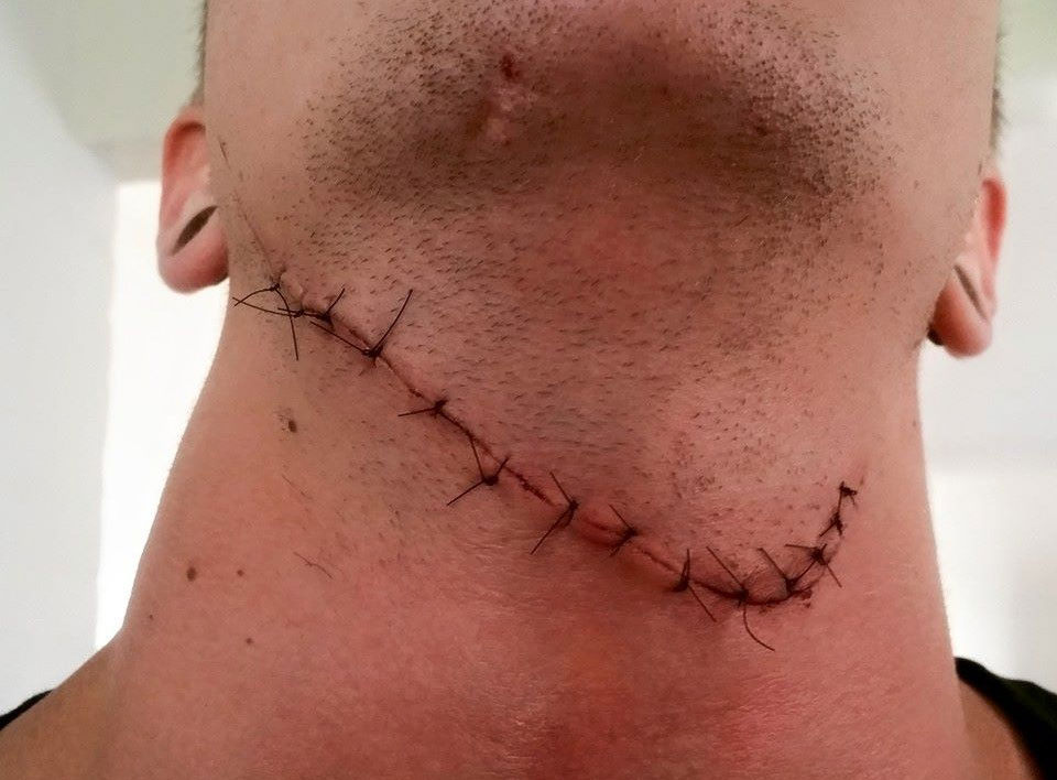 Counter-Strike Player Survives Having His Throat Cut